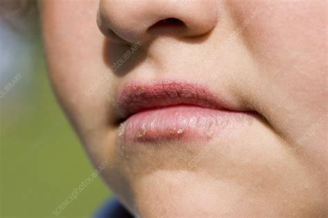 chapped stock image  science photo library