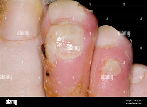 Close-up of two infected toes with neuropathy in a 73 year old male ...