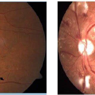 Fundus image with abnormalities. | Download Scientific Diagram