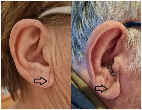 Diagonal Earlobe Crease (Frank’s Sign) for Diagnosis of Coronary Artery