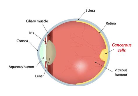 Eye Cancer | Eye Patient