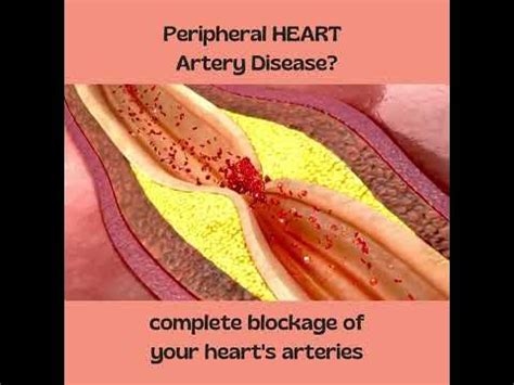Complete Heart Blockage - Symptoms of Heart Attack - YouTube