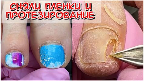 Онихолизис / Протезирование ногтей / как снять пленки с ногтей / пленки ...
