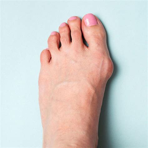 Bunion Treatment | Leading Edge Podiatry in Blackwood & Adelaide Hills