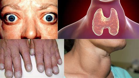 Graves' Disease Symptoms Causes Treatment & Role of Hyperthyroidism