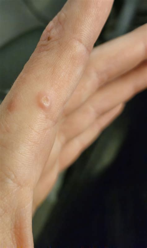 what are these warts/cysts/growths on my fingers and (lesser extent