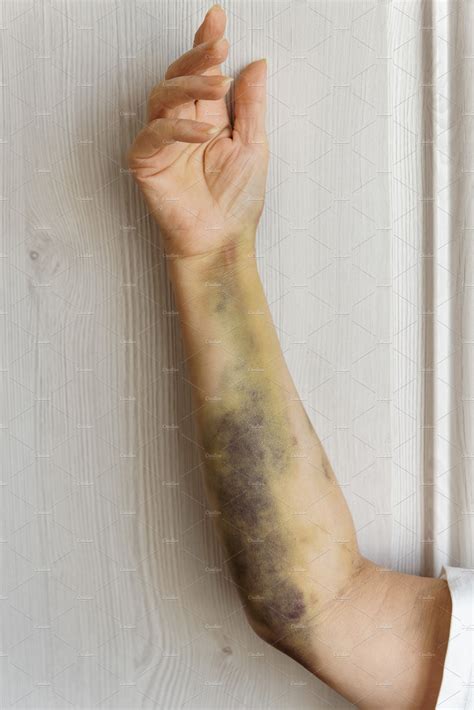 severe arm bruising  surgery health medical stock