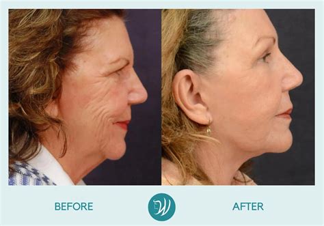 Indianapolis Skin Resurfacing Before & After Photos | Winslow Facial ...