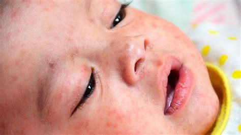 Measles outbreak across Europe - BBC News