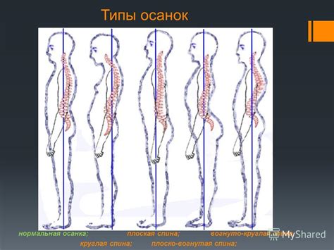 Презентация на тему: "Нарушения осанки. Как сохранить правильную осанку ...