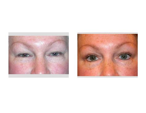 indianapolis-blepharoplasty-dr-barry-eppley-indianapolis - Explore