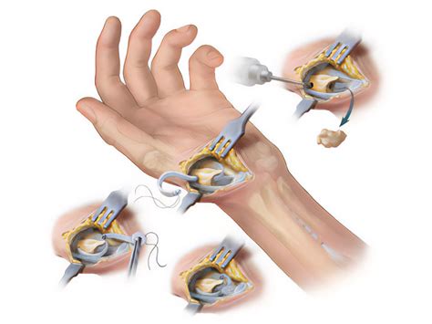 Thumb Arthroplasty Treatment | Montreal, Toronto, Ottawa, Gatineau