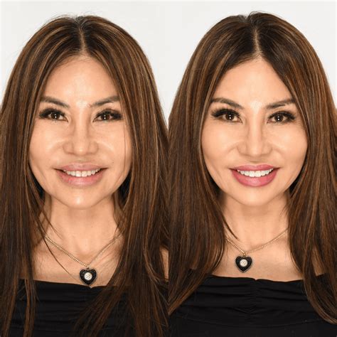 botox new jersey 9