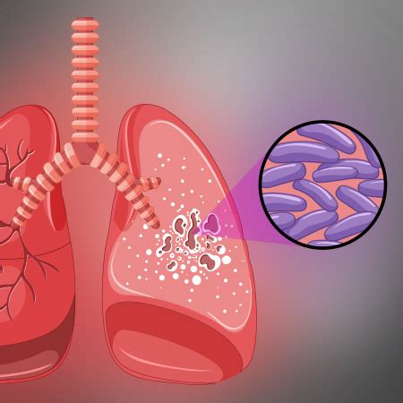 tuberculosis centre  lung health