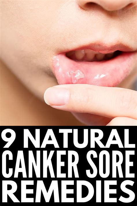 Natural and Effective: 9 Canker Sore Remedies That Work Fast