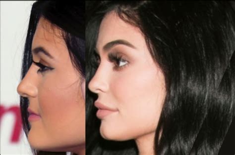 Kylie Jenner Before and After ? All of her Plastic Surgery!