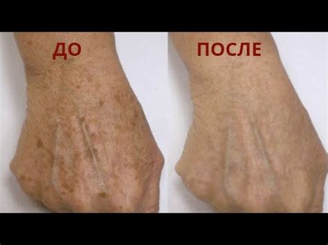 Недорогое средство от пигментных пятен! Результат уже после 1 процедуры ...