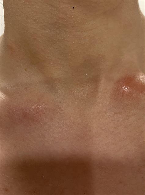 Weird rashes all over body : r/AskDoctorSmeeee