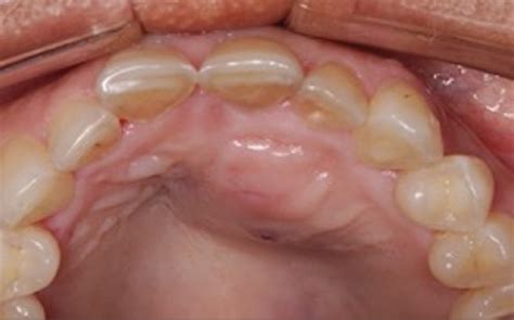 Palatal view of the extensive swelling involving patient's left maxilla ...