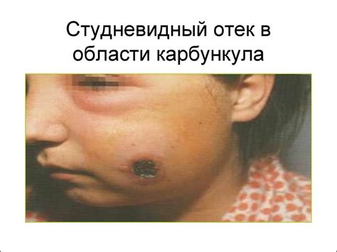 Чума. Сибирская язва - презентация онлайн