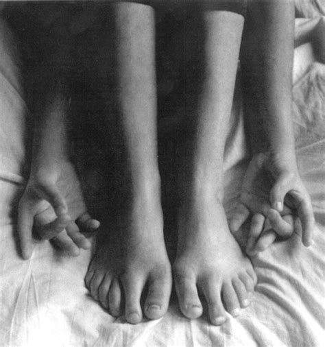 Clinical and genetic studies on 12 preaxial polydactyly families and ...