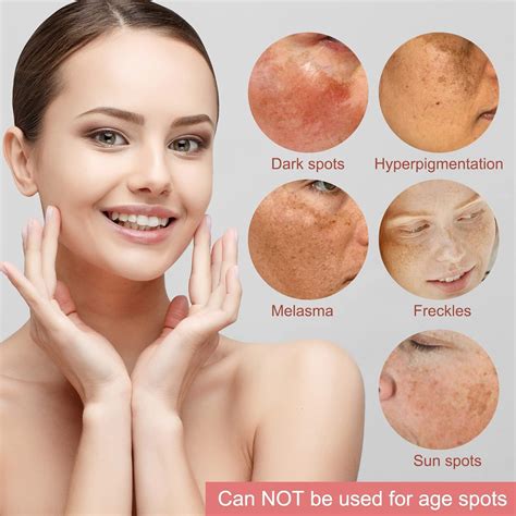 Dark Spot Remover for Face and Body - Melasma, Sun Spots, Freckle ...