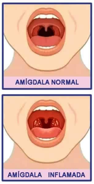 Amigdala Inchada Só De Um Lado - Amigdala Normal Vs Inchada Fotos De Amigdalite E Faringite | MD.SAÚDE