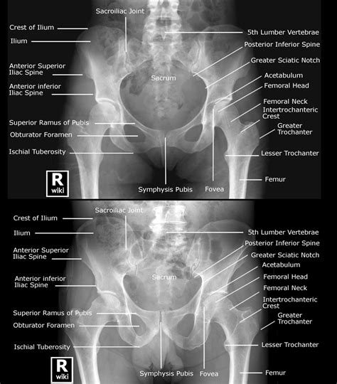 Labeled radiographic anatomy & differences between male & female pelvis
