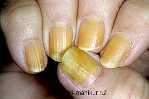 Желтый ноготь на большом пальце ноги - причины и лечение появления ...