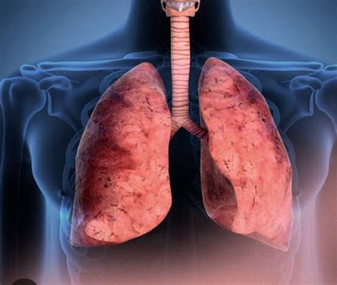 Treatment for Kartagener's syndrome - MEDizzy