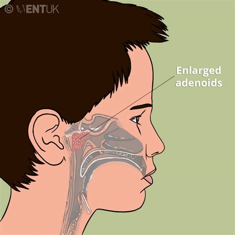 Adenoid Surgery | ENT UK