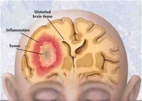 Facts About Brain Tumors | Meray Mutabiq