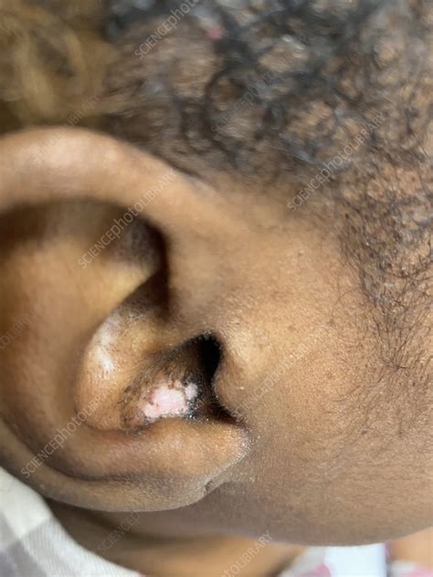 Discoid lupus erythematosus - Stock Image - C060/3481 - Science Photo ...