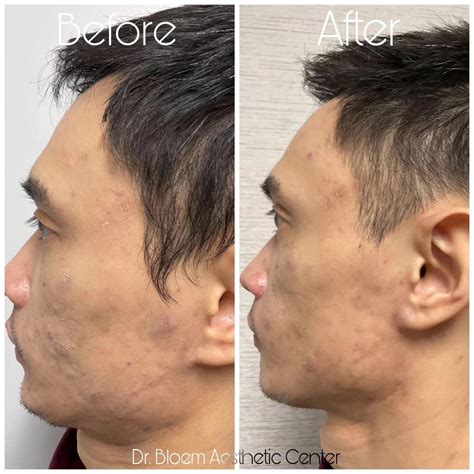 Botox - Jawline & Filler - Cheeks - Fred Bloem, MD Aesthetics