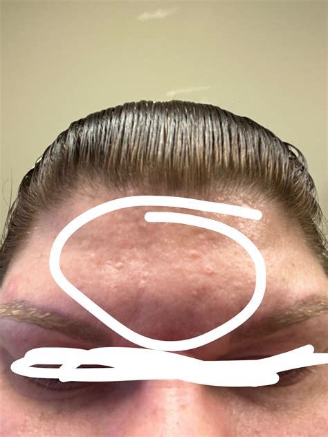 Bumps on my face : r/30PlusSkinCare