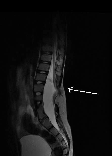 Lipomyelomeningocele-MRI - Sumer's Radiology Blog