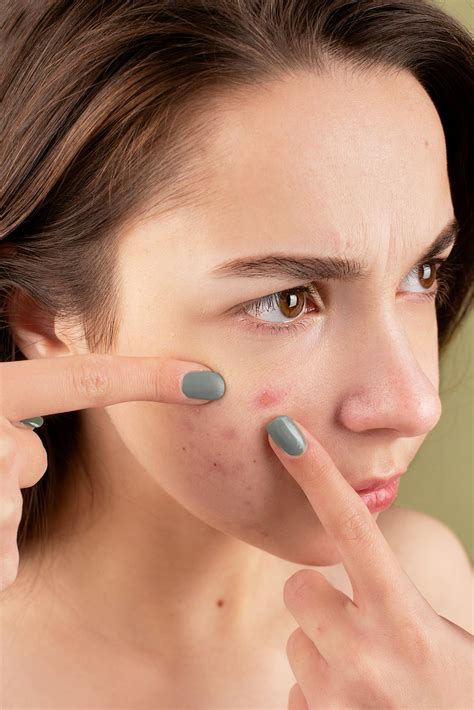 13 Best Tips to get rid of Pimples fast in 2025 - Bellflower Lifestyle