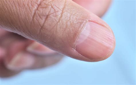 ongles striés - objectif-reponse-sante-aquitaine.fr