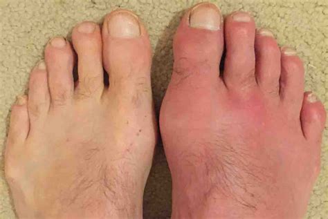 Symptoms of Gout | Things Health