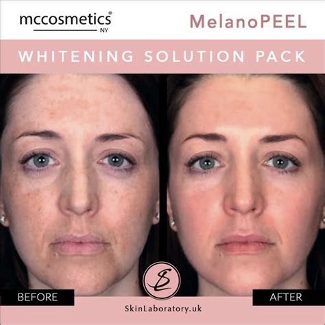 Mccosmetics Melanopeel Pack - eliminates pigmentation of melanic origin