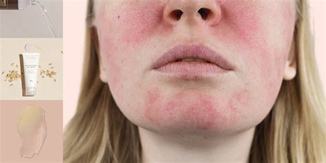 Korean Beauty For Rosacea - STYLE STORY