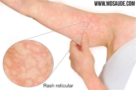 Virose Da Mancha No Corpo - 10 Causas de Febre com Manchas Vermelhas na Pele ~ Saúde e Doenças