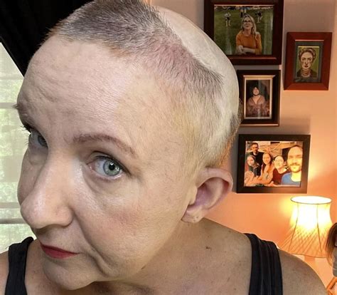 Woman told lump on head was ‘skull growth' diagnosed with cancer 20 ...