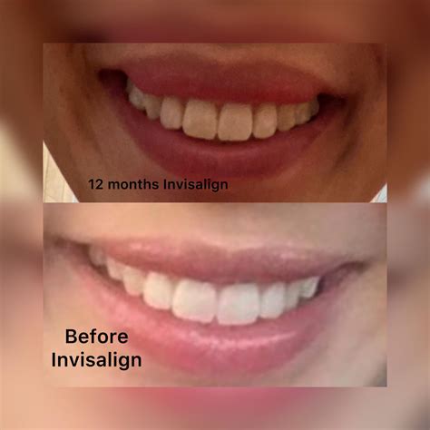 I hate the way my teeth look (it’s been 12 months into my treatment