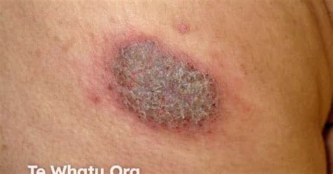 Discoid eczema image