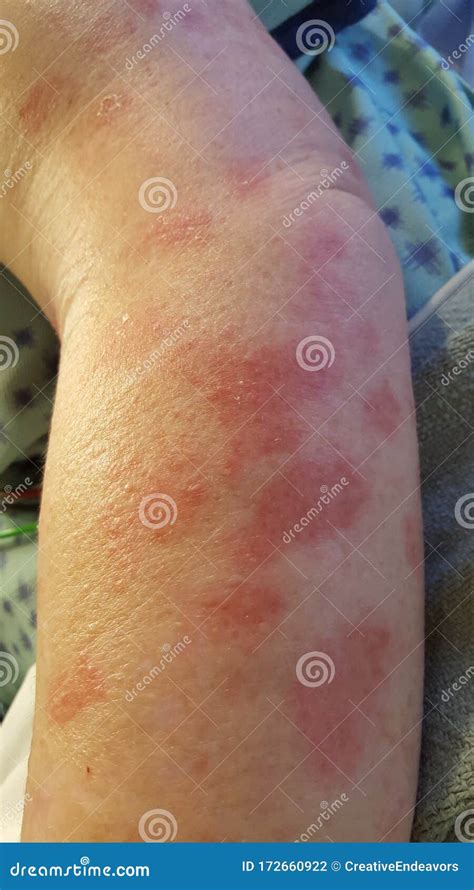 erythema multiforme annular erythematous targetoid skin lesions stock