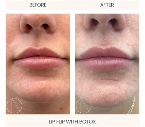inject botox   lip flip complete guide  procedure