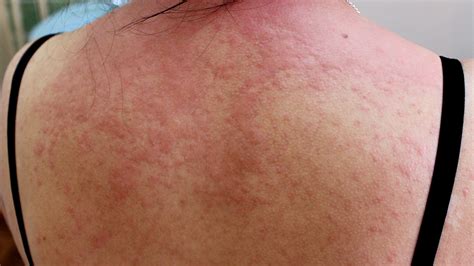 Itching: What’s Causing Your Itchy Skin? (with Pictures)