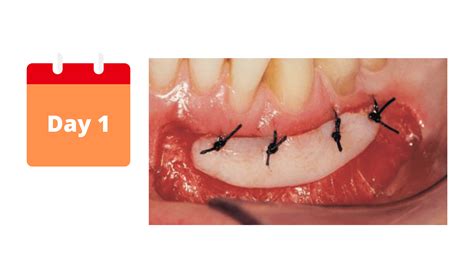 Tooth Extraction With Bone Graft Stitches at Pearline Beard blog