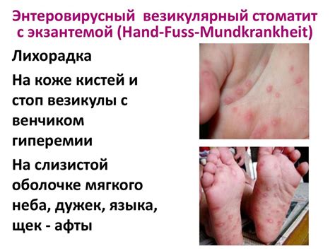 Дифференциальная диагностика поражений ротоглотки инфекционной ...